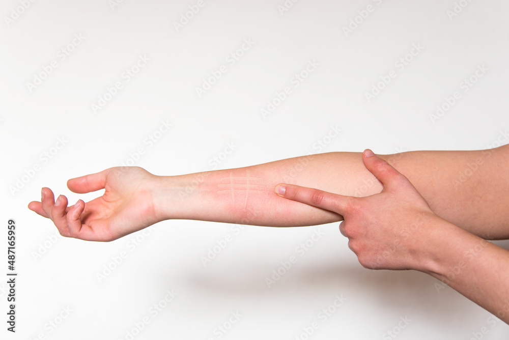 Mujer señalando a su brazo con síntomas de una afección de la piel llamada dermografismo, dermatografismo o 