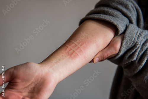 Obraz na płótnie Detalle del brazo de una mujer que padece una afección de la piel llamada dermografismo, dermatografismo o escritura en la piel, un tipo de urticaria común y benigna