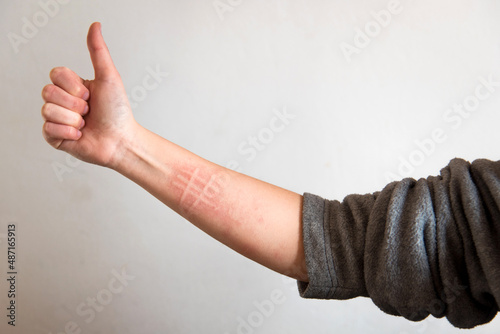 Detalle de un brazo con síntomas de una condición de la piel llamada dermografismo o dermatografismo. Mujer haciendo el signo de ok con la mano, pulgar hacia arriba photo