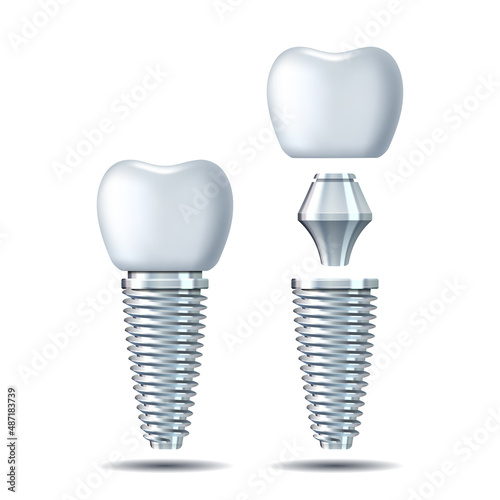 Vector 3d realistic white Tooth Implant. Denture icon closeup isolated on white