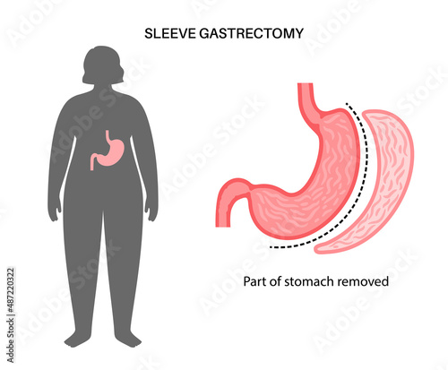Laparoscopic sleeve gastrectomy