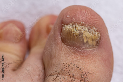 Feet of a man close-up of fingers affected by a fungal nail plate. Ugly toes.