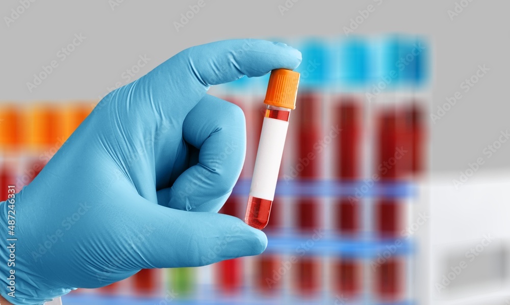 Analysis lab sample of new strain of Coronavirus Omicron.