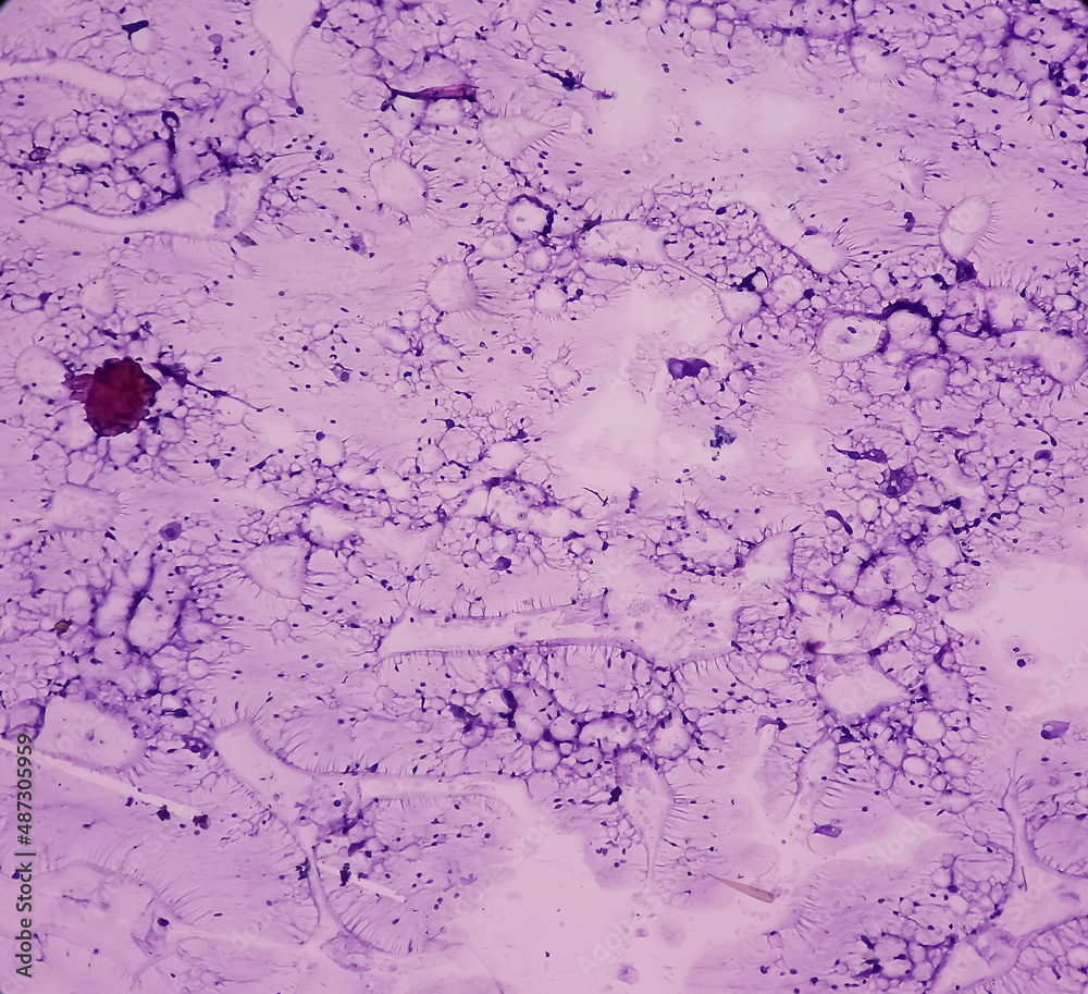 Breast lump(biopsy) Fat necrosis, injury of fatty tissue, show