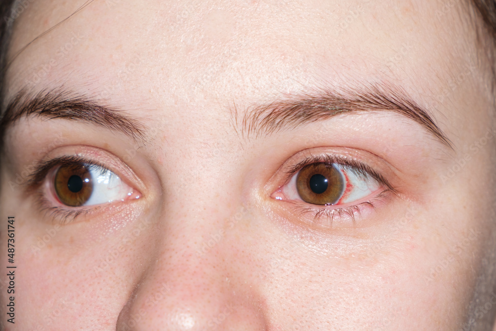Fototapeta premium Macro human eyes, burst capillaries, bruising on white of the eye. Red spot after childbirth in a woman in labor, close-up.