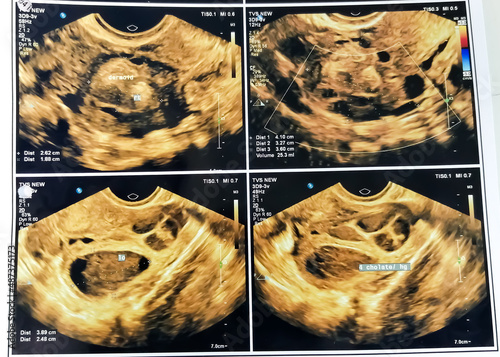 Film Ultrasound, ovarian cysts,Internal organs examination for women photo