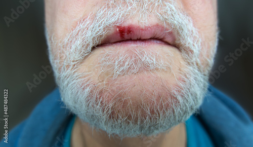 Fever blister caused by herpes simplex virus on upper lip of elderly bearded man photo