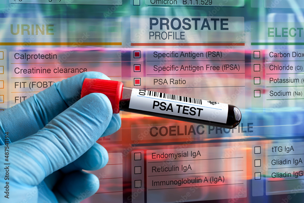 Blood tube test with requisition form for Prostate PSA test. Blood