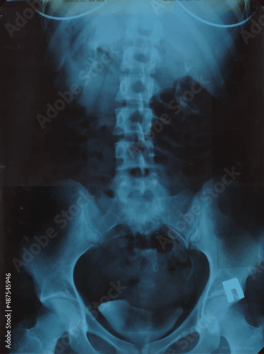 Realistic Lumbar spine x ray, pelvic bones MRI scan picture. Vector illustration