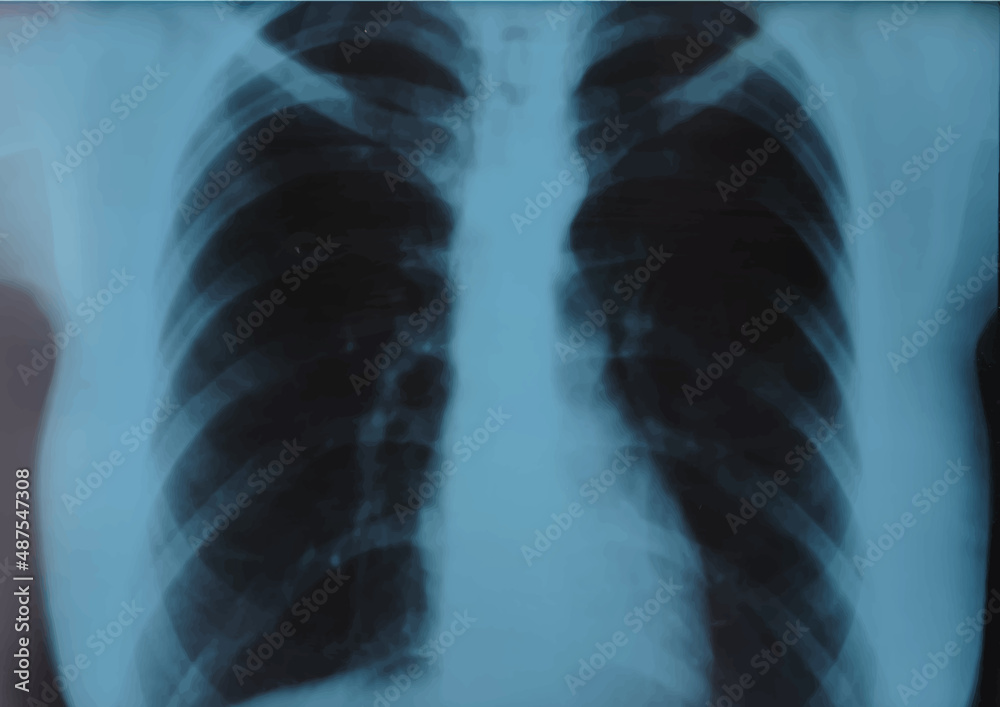 Rib MRI, X ray of thoracic spine, thorax x ray check up, fluorography image. Realistic Vector illustration Rib MRI, X ray of thoracic spine, thorax x ray check up, fluorography image. Realistic Vector illustration