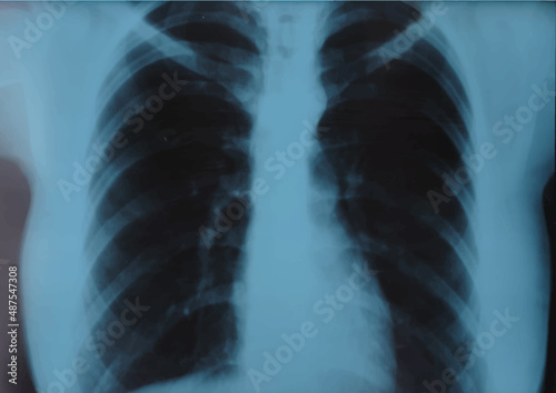 Rib MRI, X ray of thoracic spine, thorax x ray check up, fluorography image. Realistic Vector illustration