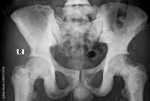 x ray image of prostat cancer metastasis on pelvis bone,difuse osteoblastic lesion photo