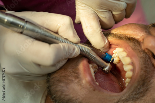 Latin American adult male (42 years old) is seen by a dentist, who performs a procedure with a drill to repair a cavity in a molar tooth. Concept of health and dentistry.