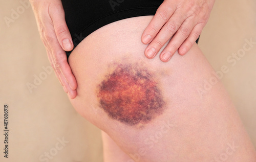 Hematoma on a woman's leg close up. Huge bruise on the leg of a woman. photo