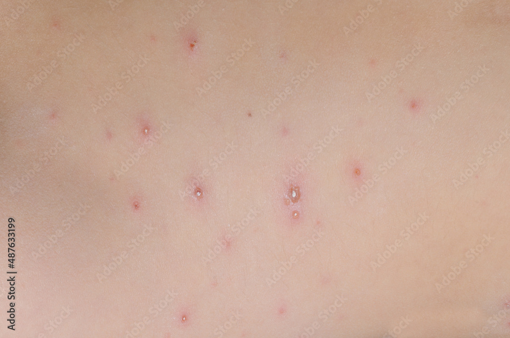 Fototapeta premium Chickenpox on the skin of a child close-up.