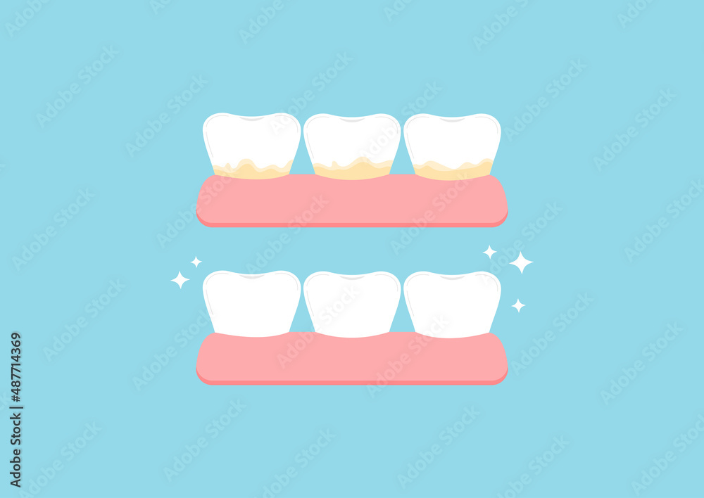 White tooth and with yellow tartar plaque before after icon set. Teeth in gum stain treatment, remove and cleaning, whitening concept. Flat cartoon vector illustration. Dental hygiene.