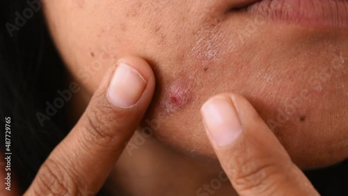 A Girl pressing pimple on her face closeup