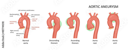 Foto Types of aortic aneurysms: root, ascending, descending,arch.