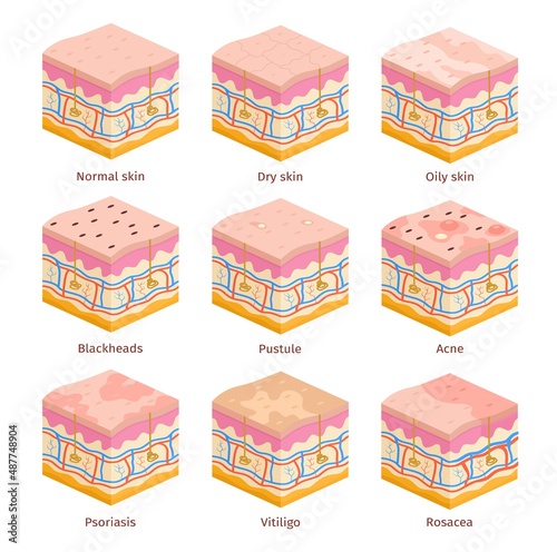 3d human skin types cross section layers. Dry, oily and normal epidermis. Skin problems, acne, blackheads, psoriasis and vitiligo vector set photo