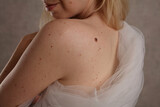 Checking benign moles : Beautiful Woman with birthmark on her back. and face. Laser skin tags removal