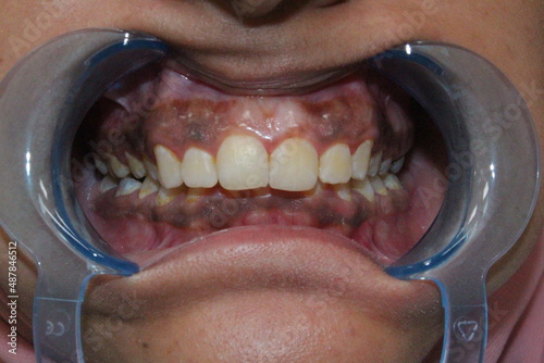 Photos gum pigmentation
