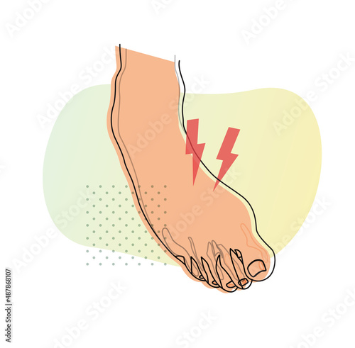 Twisted Foot- Ankle Sprain - Illustration