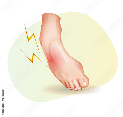 Elastic bandage for Ankle Sprain - Illustration