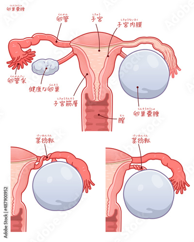 卵巣嚢腫のイラスト（テキストつき）