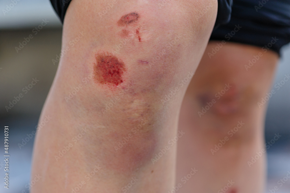 Fototapeta premium Sports injury, skateboarder with injured knees