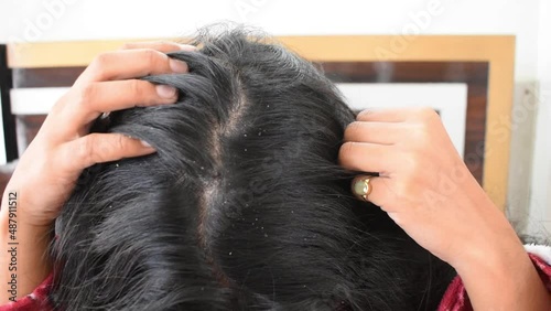 Woman's hair top view with dandruff photo