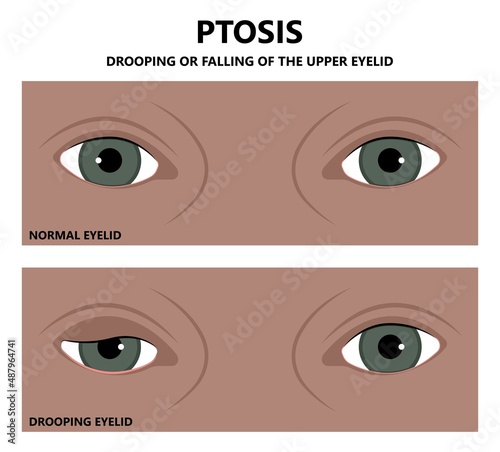 Ptosis eyelid lag Horner syndrome third nerve palsy retraction droopy