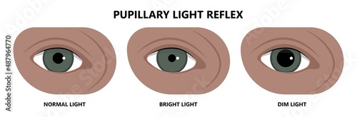miosis eye pupil size iris retina brain Horner miotic muscle dilated ocular injury ptosis reflex Marcus Gunn defect optic nerve test palsy Trauma birth Adie tonic argyll hutchinson blind diplopia exam