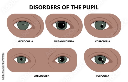 miosis eye pupil size iris retina brain Horner miotic muscle dilated ocular injury ptosis reflex Marcus Gunn defect optic nerve test palsy Trauma birth Adie tonic argyll hutchinson blind diplopia exam