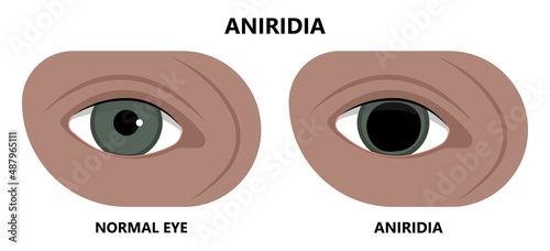 miosis eye pupil size iris retina brain Horner miotic muscle dilated ocular injury ptosis reflex Marcus Gunn defect optic nerve test palsy Trauma birth Adie tonic argyll hutchinson blind diplopia exam