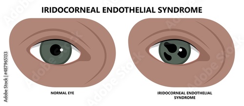 miosis eye pupil size iris retina brain Horner miotic muscle dilated ocular injury ptosis reflex Marcus Gunn defect optic nerve test palsy Trauma birth Adie tonic argyll hutchinson blind diplopia exam