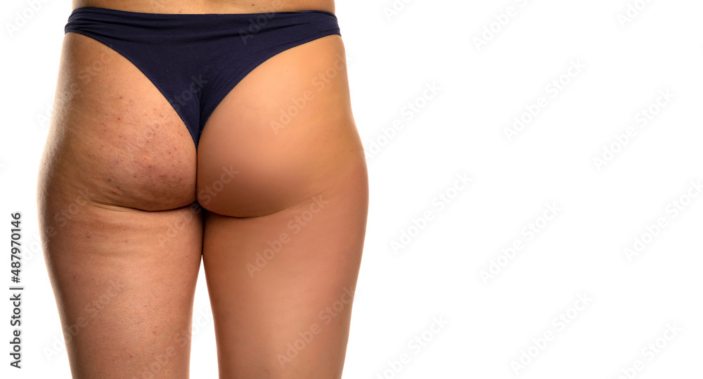 Female buttocks before and after treatment Female buttocks before and after treatment