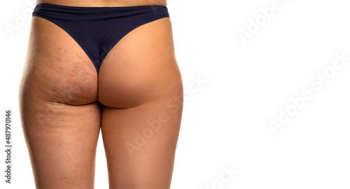 Female buttocks before and after treatment photo