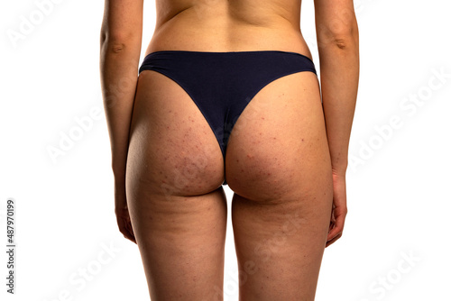 woman's buttocks with problematic skin and pimples and cellulite