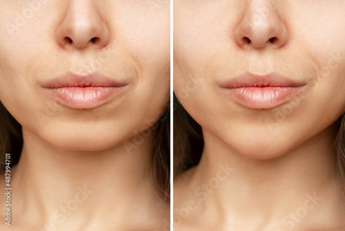 Сhin reduction. Cropped shot of woman's face with chin before and after mentoplasty. The result of cosmetic plastic surgery. Beauty concept photo