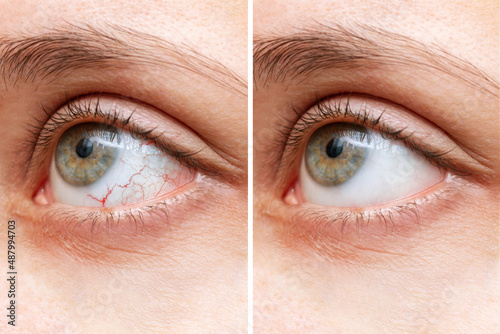 Fototapeta Close-up of female eye with red inflamed and dilated capillaries before and after treatment