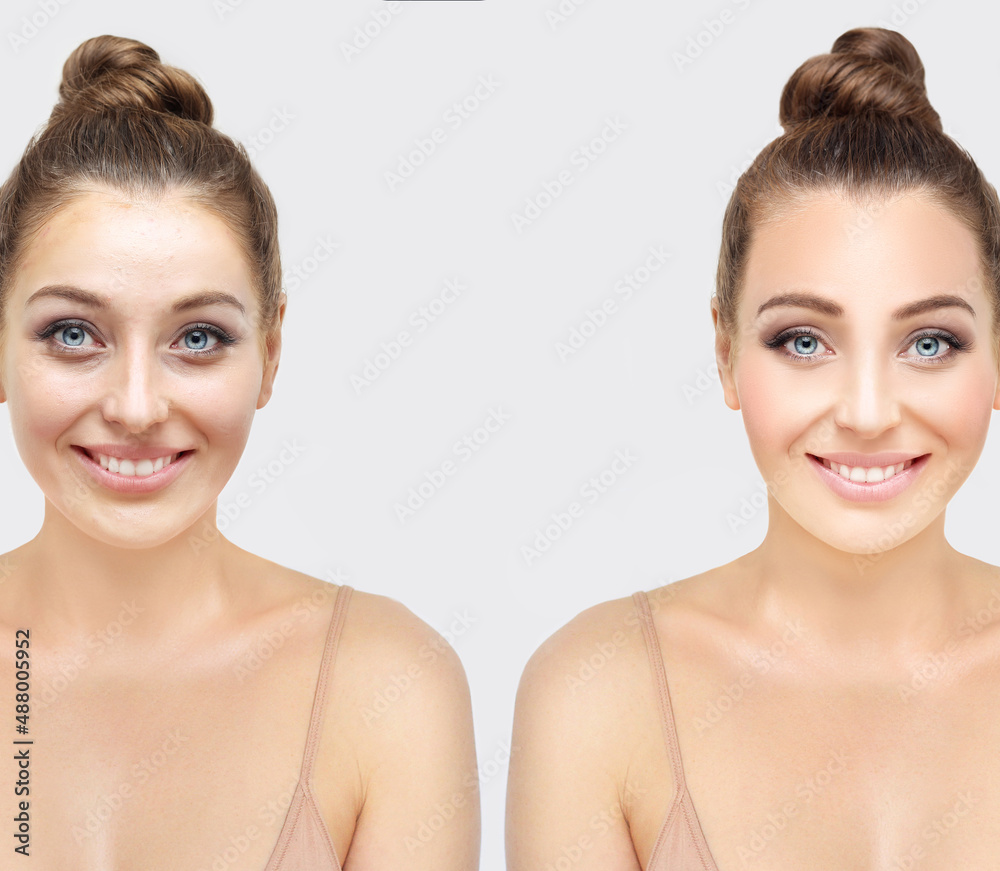 The Secret of Makeup. Before- After,Portrait of beautiful girl with problem and clear skin The Secret of Makeup. Before- After,Portrait of beautiful girl with problem and clear skin