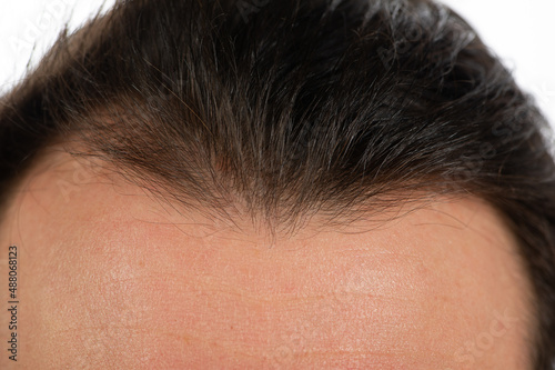 receding hairline showing a high forehead of a man