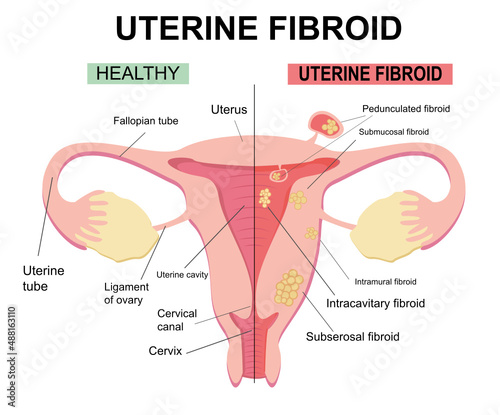 Types of uterine fibroids. Disease of the female reproductive system. Reproductive system picture displays pedunculated, intracavitary, submucosal, subserosal. Flat illustration of  myoma, leiomyomas. photo