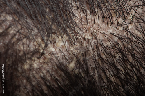 macro view of hair root or scalp with dandruff, seborrheic dermatitis