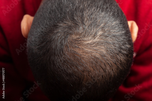 crown head, bald scalp of a man suffering from hair loss or Androgenetic alopecia photo