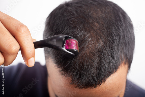 hair loss treatment through dermaroller or Microneedling photo