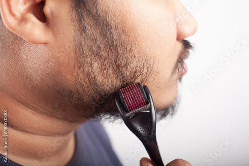 using Microneedling or collagen induction therapy for beard hair growth photo
