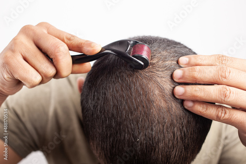 man applying microneedling hair loss treatment for bald scalp photo