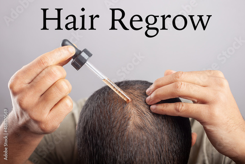 man applying hair loss serum or minoxidil on bald scalp photo
