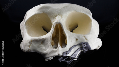 dental skull with zygomatic metal template for zygomatic implants photo